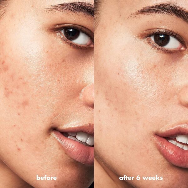 e.l.f. SKIN Blemish Breakthrough Blemish Control Basics Kit, Travel-Size Acne Skincare Routine
